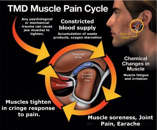 TMJ PAIN CYCLE ILLUSTRATION